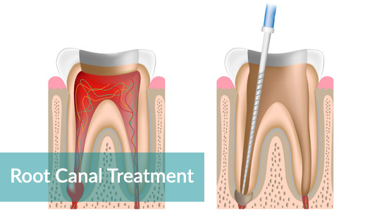 Root Canal Treatment by Dr. Elsa Bracamontes